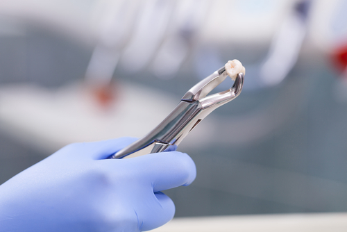 an extracted tooth
